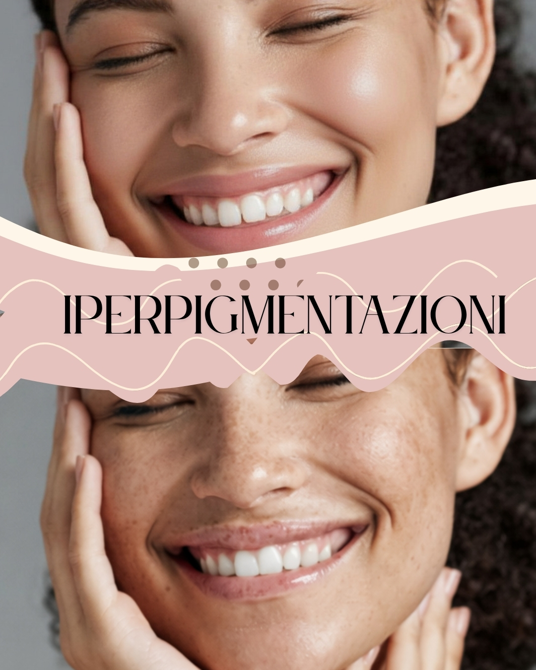 Trattamenti viso Guidonia - Iperpigmentazione e macchie scure
